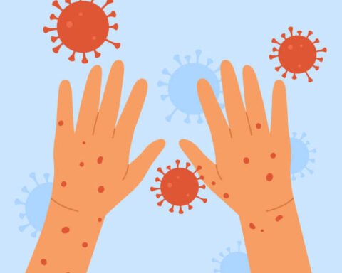 Monkeypox Virus Human Hands With Monkeypox Skin Infection Concept An Outbreak Of A Smallpox.jpg