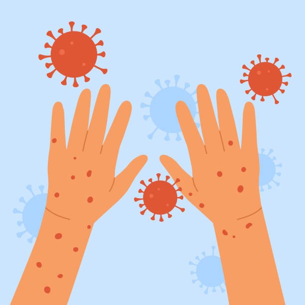 Monkeypox Virus Human Hands With Monkeypox Skin Infection Concept An Outbreak Of A Smallpox.jpg